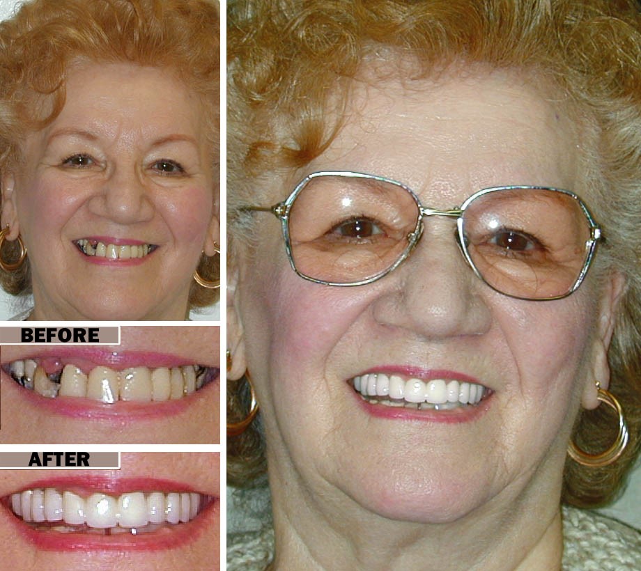 Partial 
      Dentures Before And After Fort Worth TX 76126